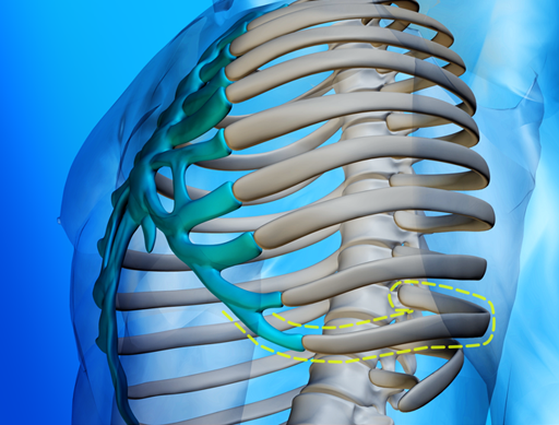 Step 1 in fixing Slipping Rib Syndrome