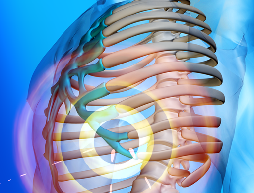 Slipping Rib Syndrome: UHC Provides Non-invasive Treatment