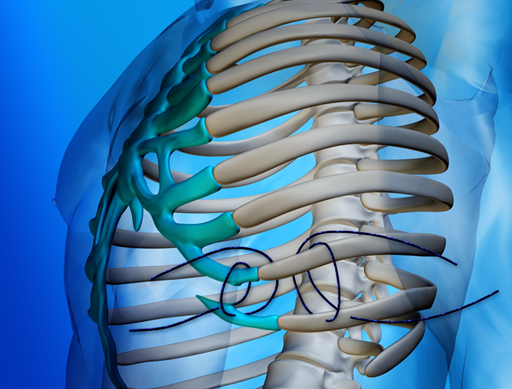 slipping-rib-syndrome-uhc-provides-non-invasive-treatment-united