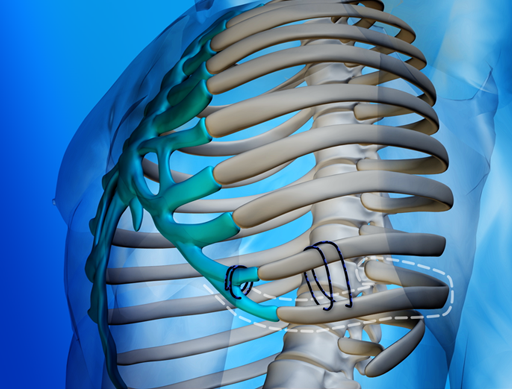 Back Pain and Slipped Rib